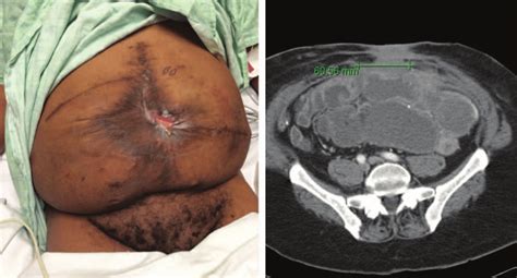 Multiple Recurrent Enterocutaneous Fistula Patient With Scarred Skin