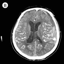 Enhanced Computed Tomography CT Of Brain Shows Subacute Subdural