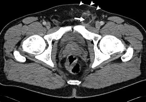 Inguinal Hernia Ct Scan