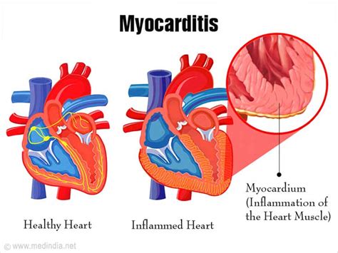 Myocarditis Types Causes Symptoms Complications Treatment Prognosis