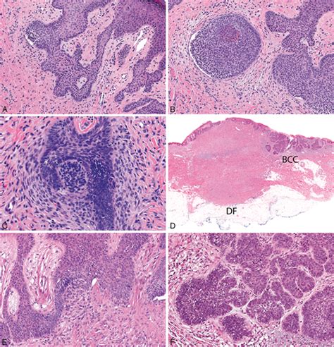 Histologic Mimics Of Basal Cell Carcinoma Archives Of Pathology