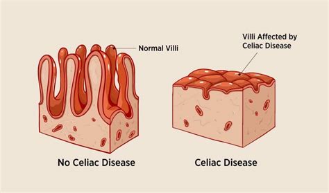 Endoscopy Biopsy Celiac Disease At David Mays Blog