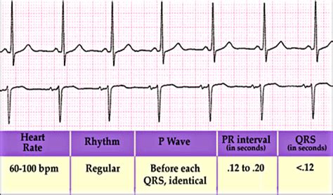 Ecg Flashcards Quizlet