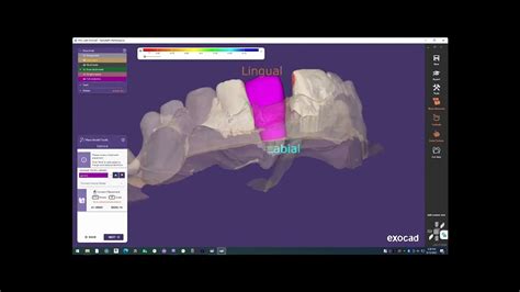 Switching Exocad Implant Scanbody After Scanning Youtube