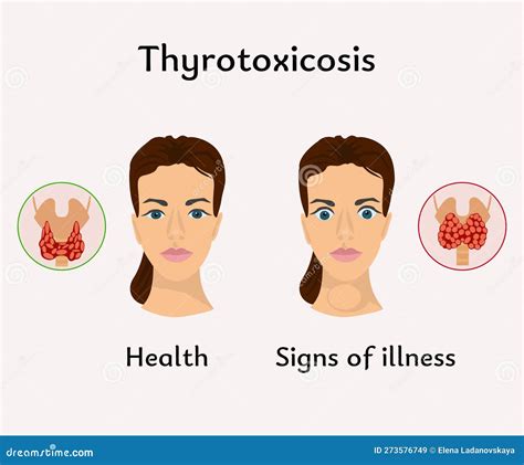 Thyrotoxicosis Thyroid Gland Medical Poster Stock Vector Illustration Of Thyrotoxicosis