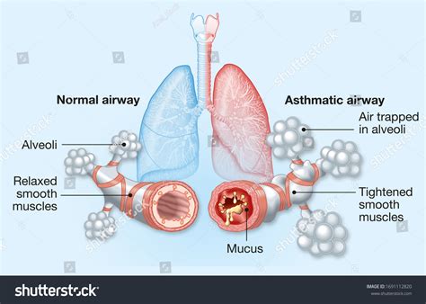 32,740 Asthma Lung Images, Stock Photos & Vectors | Shutterstock