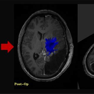 Postoperative Magnetic Resonance Imaging Showing Near Total Resection