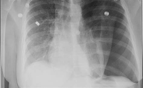 Case of the Day: Dextrocardia