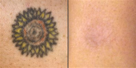 Natural Tattoo Removal How To Remove Tattoos Naturally