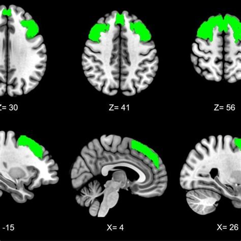 Bilateral Dorsolateral Prefrontal Cortex Seed Across Axial Top And Download Scientific