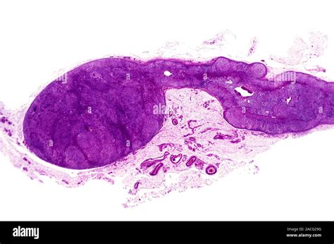 Adrenal gland tumour. Light micrograph of a section through an adrenal gland containing a ...