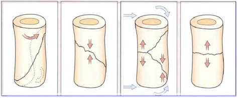 Fracture in the Arm | Mind Map