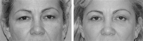 Complications In Blepharoplasty How To Avoid And Manage Them Pmc