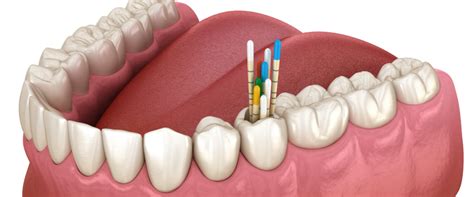 benefits  endodontic treatment  comprehensive guide