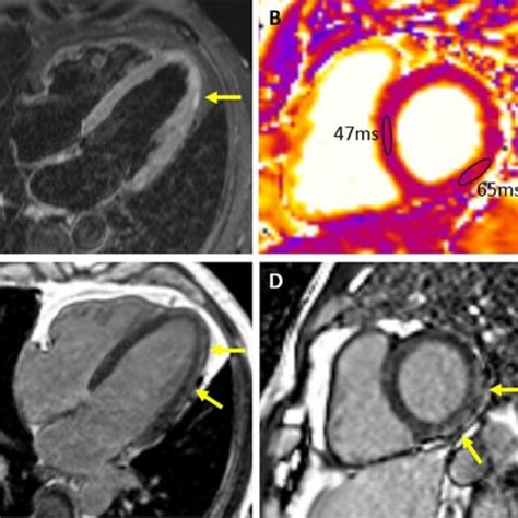 Cmr Of A Patient With Acute Myocarditis 4 Chamber Tirm Image A High