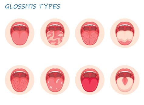 Bacterial Tongue Oltre 353 Immagini Vettoriali E Grafica Vettoriale Stock Acquisibili In