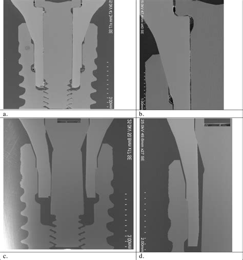 Straumann Bone Level Implant Restored With Ab Straumann Cares