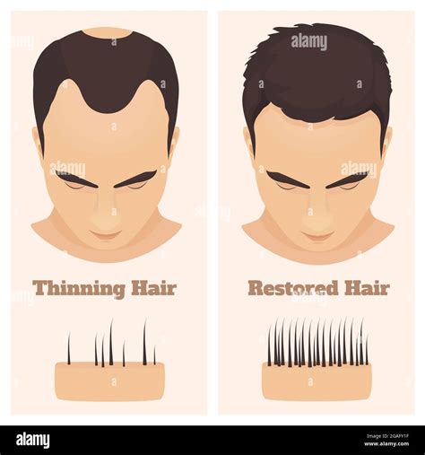 Stages Male Pattern Baldness Hair Loss Alopecia Asian Men Vector Stock