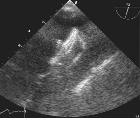 Images Of The Amplatzer Cardiac Plug Acp In Situ A Toe B