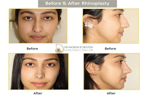 Frequently Asked Questions Faqs About Rhinoplasty Dr Denton