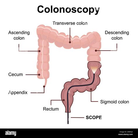 Concept De Technologie De Coloscopie Avec Endoscope De Rendu à L