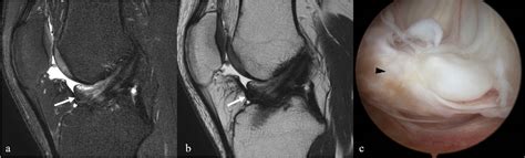 Figure 2 From Cyclops Lesions Associated With Both Bundles And