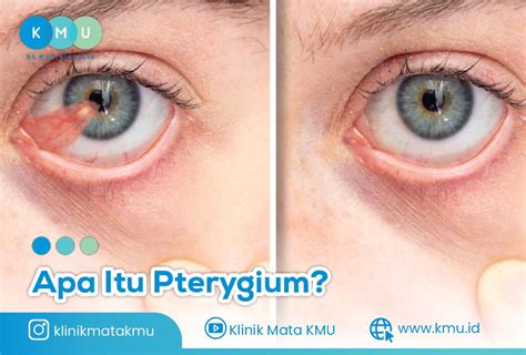 Penyakit Pterygium Gejala Penyebab Cara Mengobati