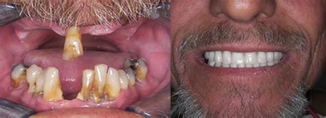 Dental Care Center Of Hollywood Dental Implants Ental Implants Can Improve Your Quality Of