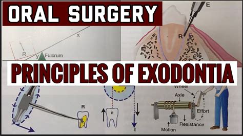 Principles Of Exodontia Ii Tooth Extraction Ii Oral Surgery Ii Imp