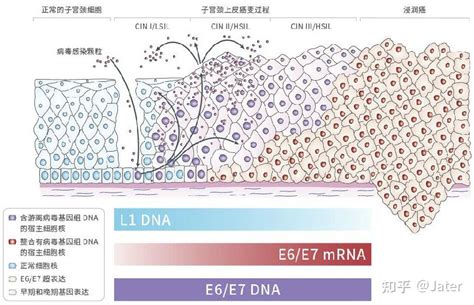 为什么要检测hpv E6e7 Mrna呢？ 知乎