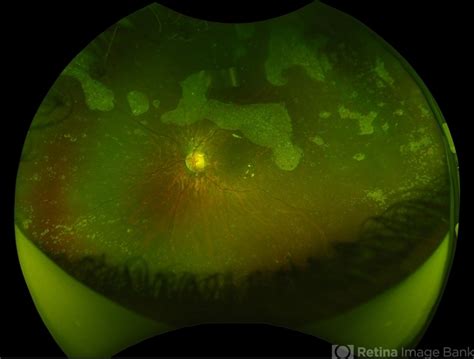 Silicone Oil Emulsification On Ultra Widefield Retinal Imaging Retina