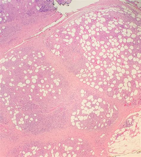 Erythema Induratum Histopathology