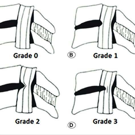 A D Schematic View Of The Degree Of Cervical Canal Stenosis 5 A