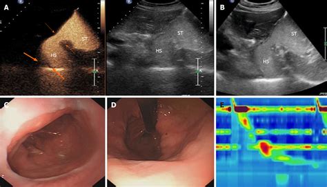 Gastroesophageal Junction Ultrasound