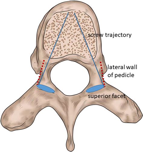 The Projection Of Lateral Border Of The Superior Facet On The Pedicle