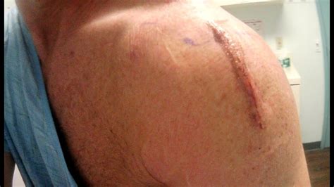 Skin Scarring After Shoulder Rotator Cuff And Biceps Surgery Youtube