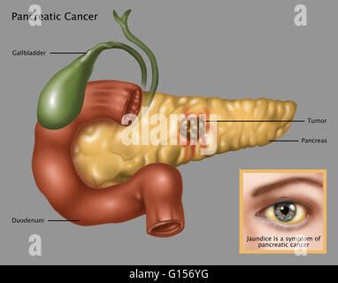 Ilustraci N Del C Ncer De P Ncreas En El Centro Del P Ncreas Es Un