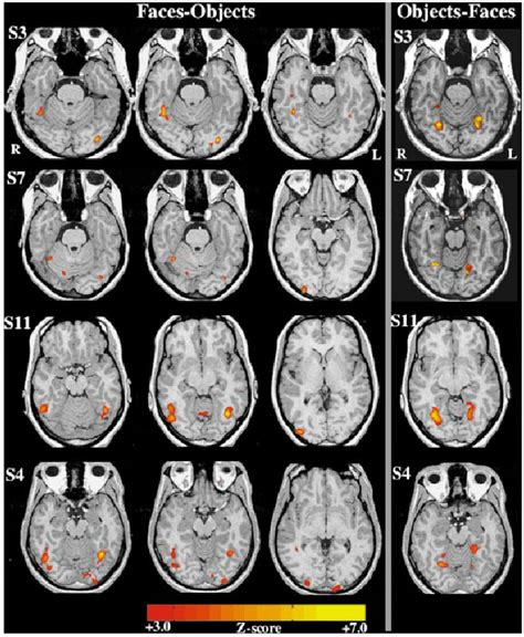 Localization Of The Fusiform And Occipital `face Areas And The