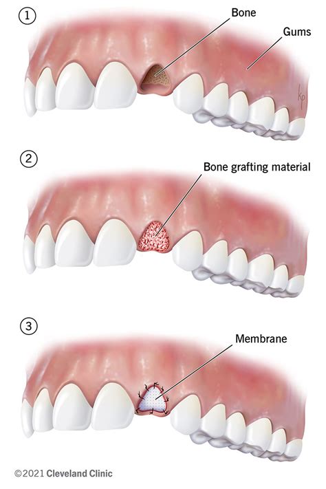 How To Bone Graft Dental Implants Dentist Norcross Alpharetta GA