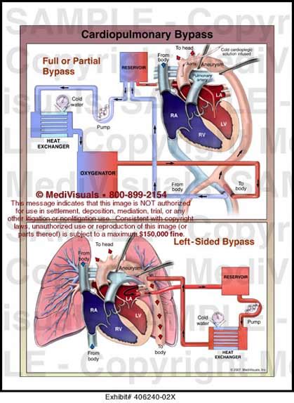 Cardiopulmonary Bypass Medical Illustration Medivisuals