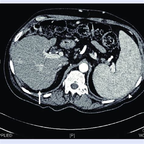 Ultrasound Scan Of A A Normal Liver B Liver With Mild Fat