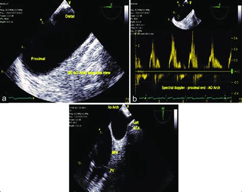 A Upper Esophageal Aortic Arch Long Axis View B Spectral