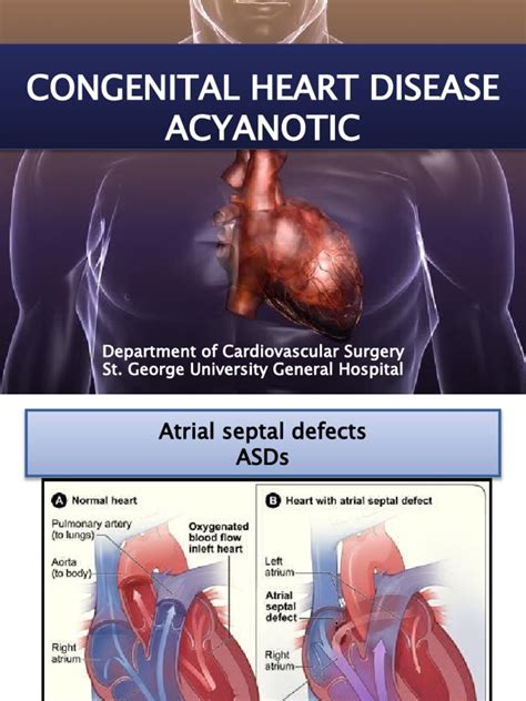 Congenital Heart Disease Acyanotic Department Of Cardiovascular