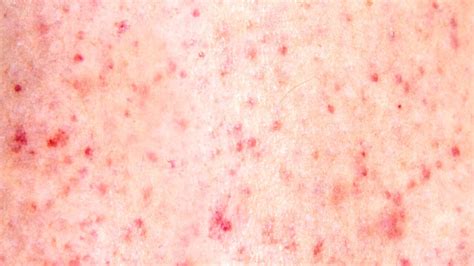 leukemia  tiny red spots  skin understanding petechiae