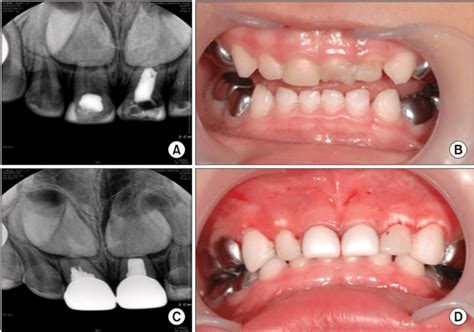 Clinical Photographs And Periapical Radiographs Of Case A B