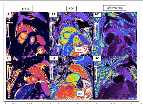 Figure From Cardiac Magnetic Resonancederived Extracellular Volume