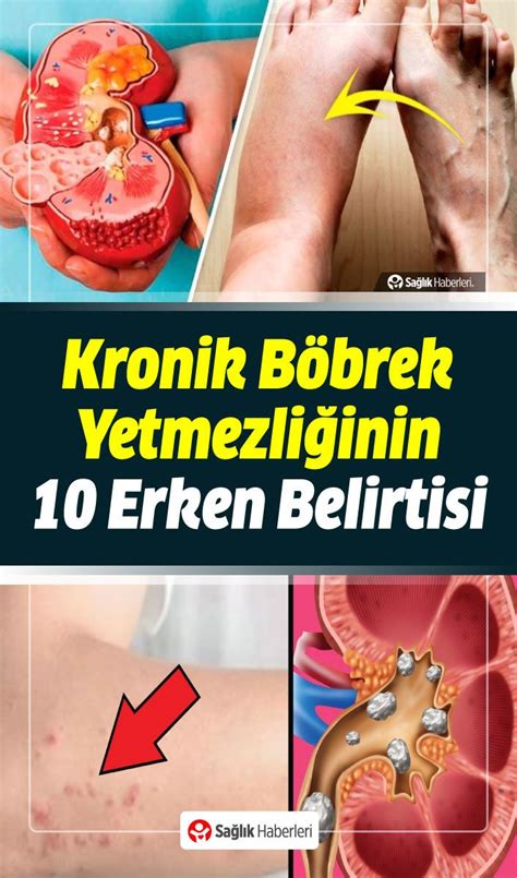 Böbrek Yetmezliği Nedir Böbrek Yetmezliğinin Erken Belirtileri