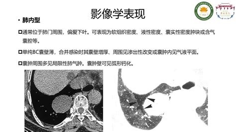 【病例】支气管源性囊肿1例ct影像 影像ppt