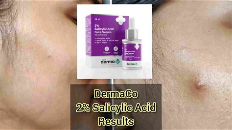 The Derma Co Salicylic Acid Serum Honest Review Serum For Acne