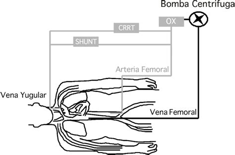 Cortocircuito Veno Arterial Arterio Venoso Mixto Crrt Terapia De